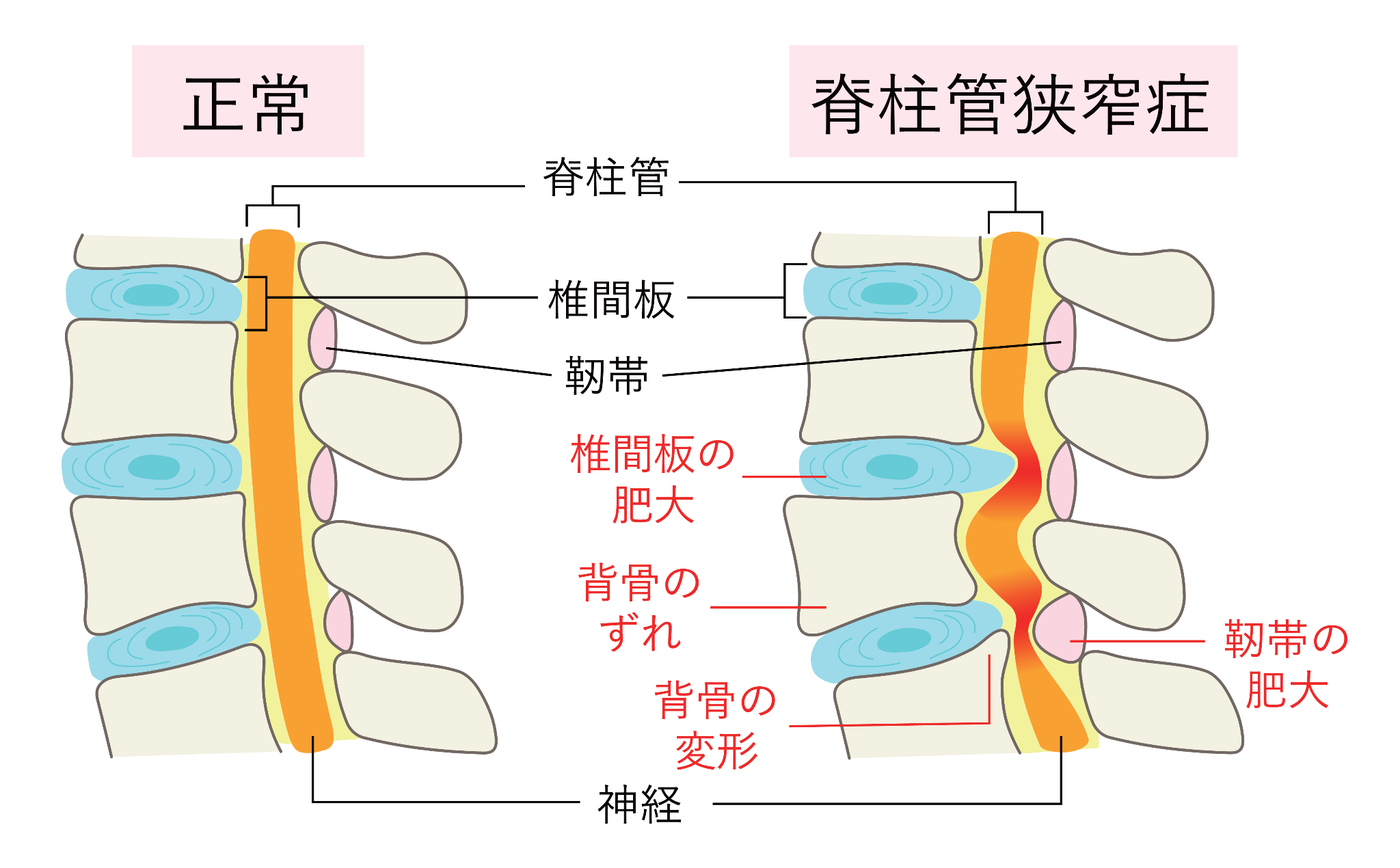 腰痛図②